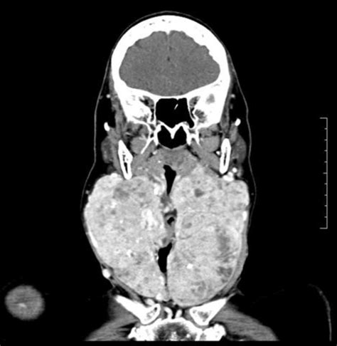 Multinodular goiter – Elearn Radiology