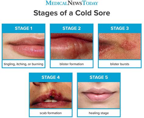 How long do cold sores last? Stages, pictures, and treatments