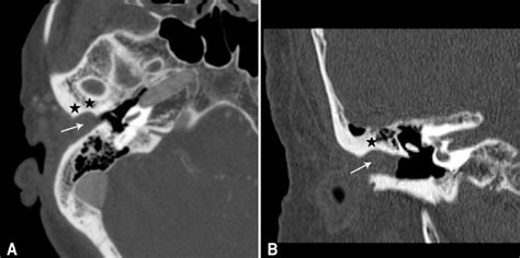 Enhanced axial (A) and coronal (B) temporal bone CT scan shows an about ...