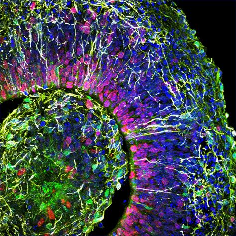 Preterm baby-like brain waves detected in lab mini-brains