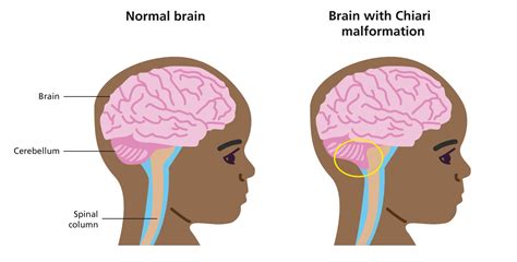 Cranio-cervical decompression for chiari malformation - Resource ...