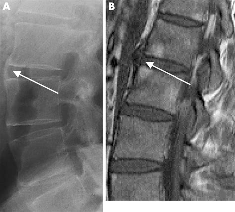 Ankylosing Spondylitis Mri