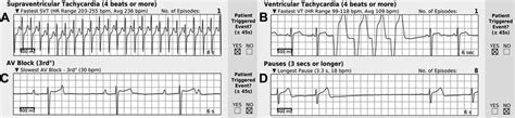 Sample Zio Patch reports. (A) SVT, (B) VT, (C) third-degree ...