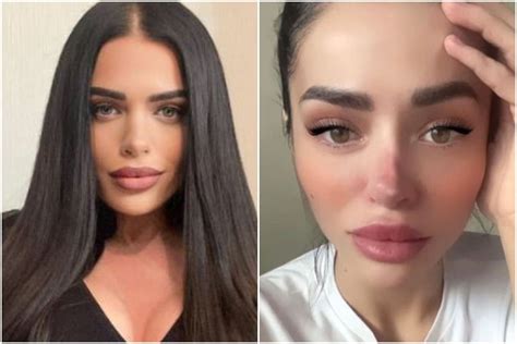 Reality Star Left With Rotting Nose After Botched Plastic Surgery, Begs ...