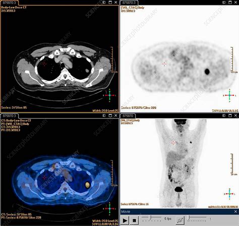 Lung cancer, PET scan - Stock Image - F007/9764 - Science Photo Library