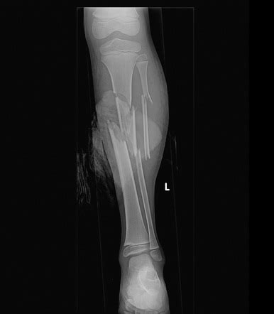 Tibia And Fibula Compound Fracture