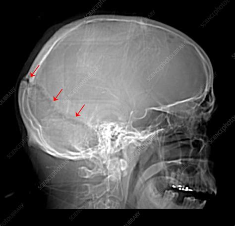 Skull Fracture on X-Ray - Stock Image - C027/1705 - Science Photo Library