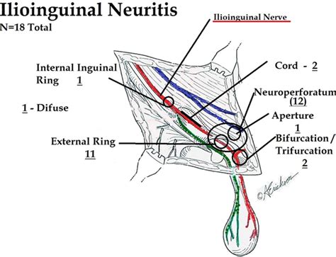 Inguinal Neuritis in Open Recurrent Hernia Repair