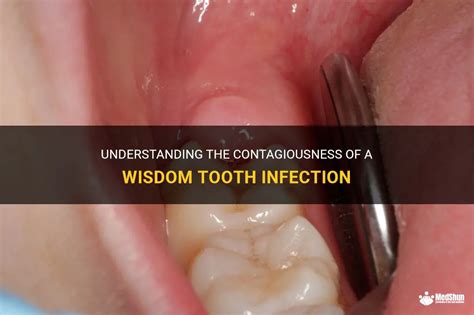 Understanding The Contagiousness Of A Wisdom Tooth Infection | MedShun