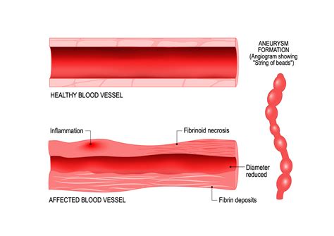 Vasculitis - Arthritis Treatment Center