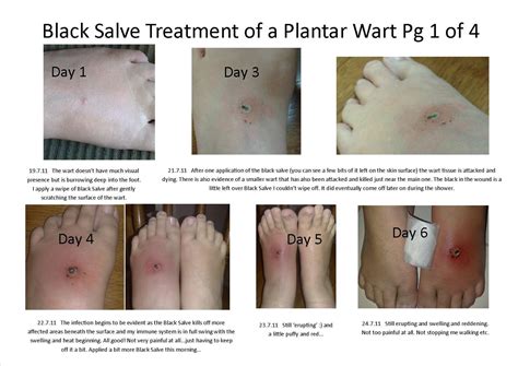 Plantar Wart Causes And Treatment | Gallery Demax