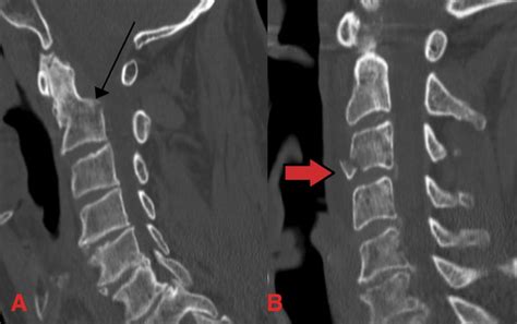 Cervical Fracture - TeachMeSurgery