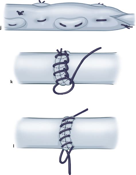 Techniques of Tendon Repair | Plastic Surgery Key