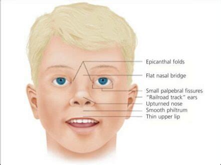 Down Syndrome (Trisomy 21) Nursing Care Planning and Management