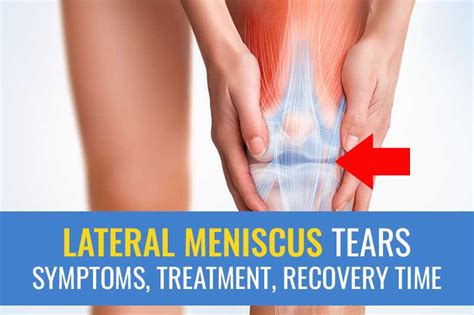 Lateral meniscus tears: Symptoms, treatment (surgery vs. exercise), and ...