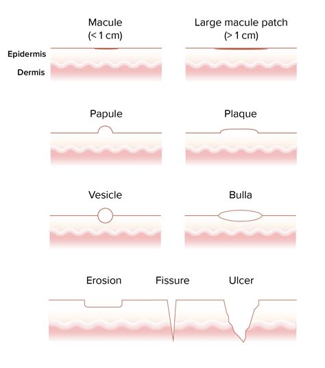 Macule Vs Papule