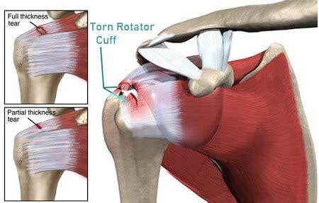 Torn Rotator Cuff Symptoms And Treatment - Shoulder Pain Explained