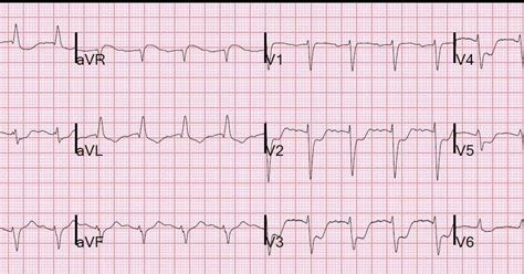 Dr. Smith's ECG Blog: Beware confusing the diagnosis of posterior STEMI ...