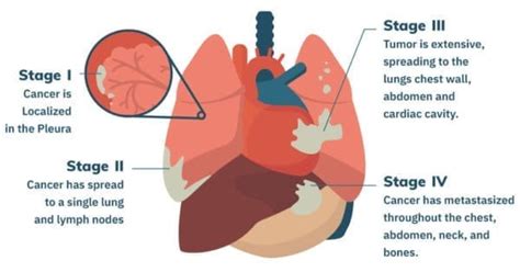 Mesothelioma Pictures | Mesothelioma.com