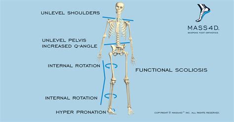 What Is Functional Scoliosis? - MASS4D® Foot Orthotics