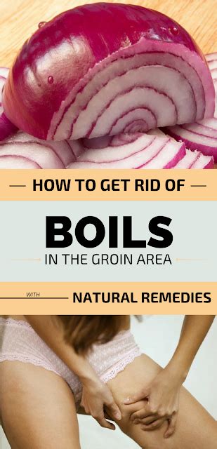 Home Remedies to Get Rid of Boil | Get rid of boils, Boil remedies ...