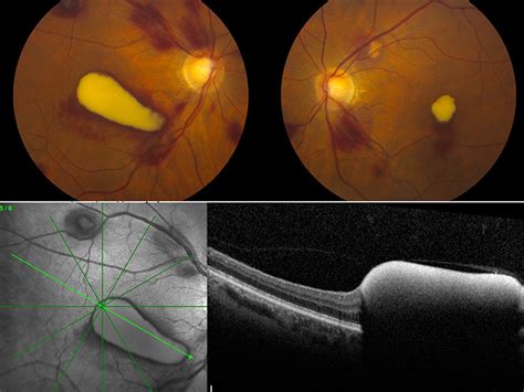 Atlas Entry - Valsalva Retinopathy with Sub-ILM hemorrhages in the ...