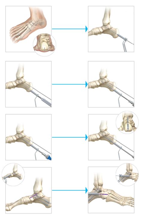 Triple Arthrodesis | Acutrak Advantage