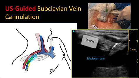 Better With Ultrasound: Subclavian Central Venous Catheter, 41% OFF