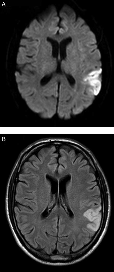 Superior Temporal Gyrus Mri