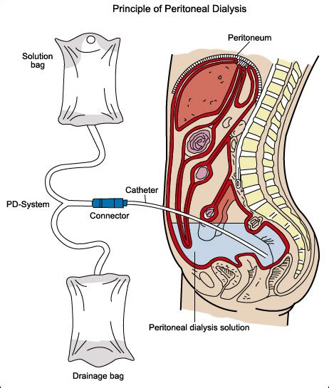 タビビッド 注入peritonedialysis Auscultation Palpation Computer Vivid Arterial ...