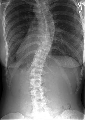 Scoliosis: Identification, Treatment, and Prevention