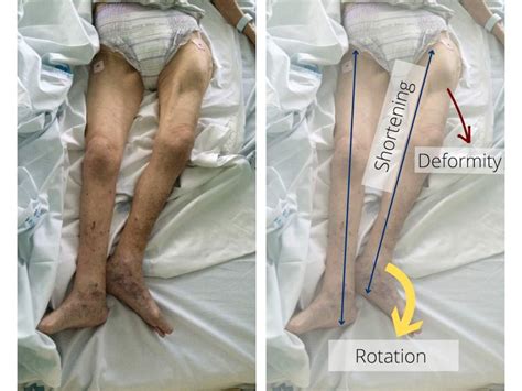 Femoral Fractures: No Time To Lose - Pro doctor