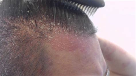 scalp psoriasis hair loss - pictures, photos