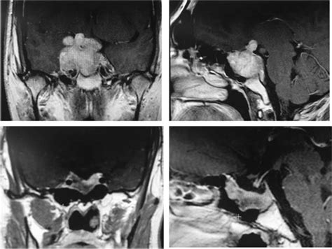 Coronal and sagittal planes from pituitary MRI of a giant prolactinoma ...