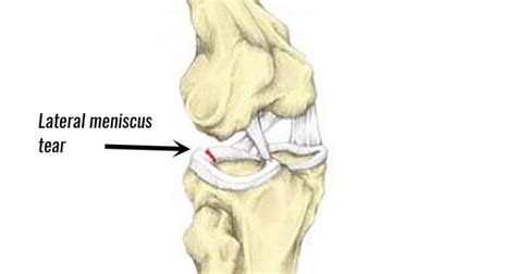 Knee joint pain Archives - Sportsinjuryclinic.net