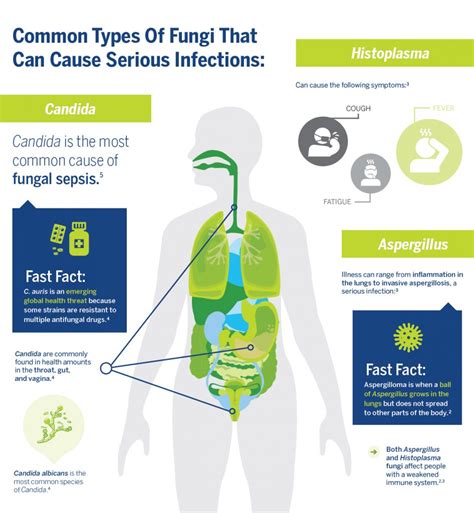 Blanca Pearson Berita: Candida Auris Fungal Infection Symptoms