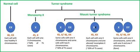 Monosomy Turner Syndrome