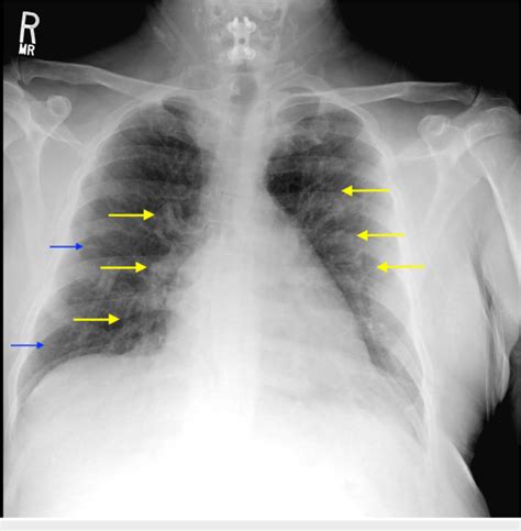 Chest X-ray of the patient The image displays the development of ...