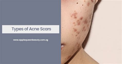 Types of Acne Scars - Apple Queen Beauty