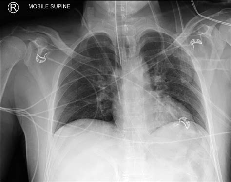 Endotracheal Tube Placement X Ray