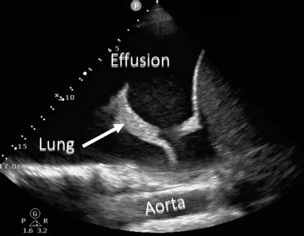 Thoracic Ultrasound: More Pleural Effusions