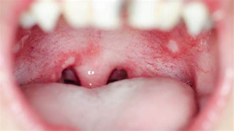 White Spots On Throat: Causes And Treatments - Aether Health - Kingwood ER