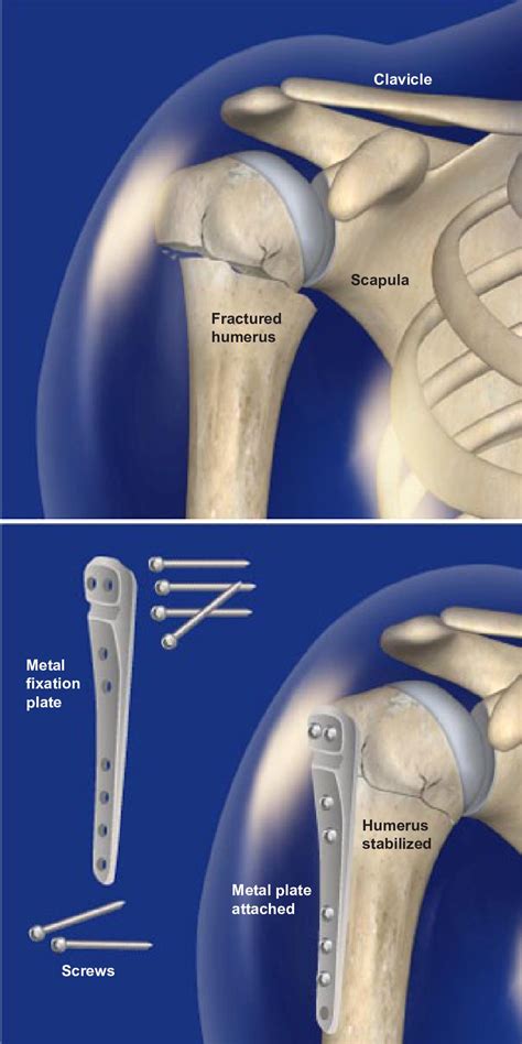 Types Of Proximal Humerus Fractures