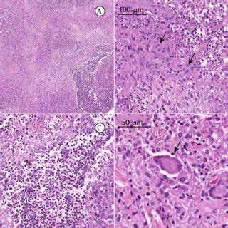 -Photomicrographs of a cervical lymph node biopsy sample. Lymphoid ...