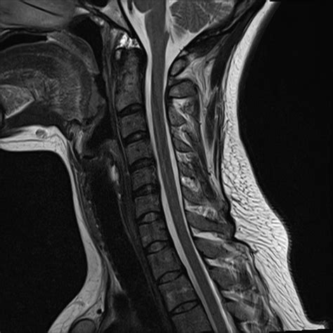 Normal Cervical Spine Mri | www.imgkid.com - The Image Kid Has It!