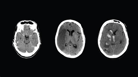 What Is A Ct Scan Of The Brain Without Contrast