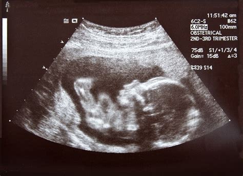 Keepsake Ultrasounds - American Pregnancy Association