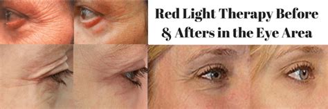 Dpl Light Therapy For Wrinkles | Shelly Lighting