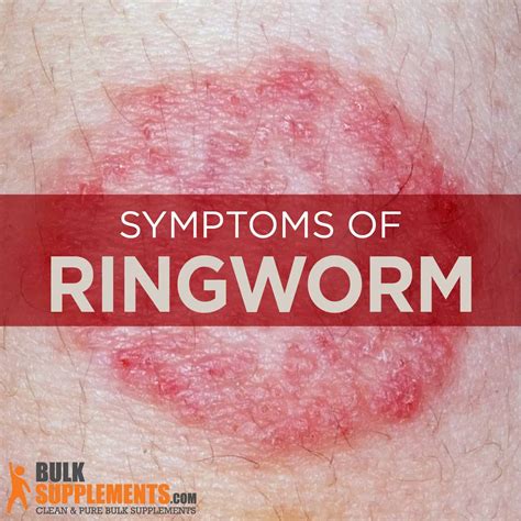 Can A Human Get Ringworm From A Dog