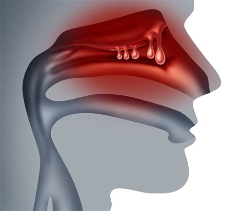 Dupilumab Effective, Safe in Chronic Rhinosinusitis With Nasal Polyps ...